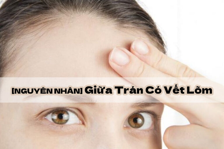 giữa trán có vết lõm