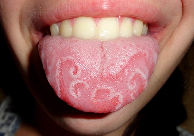 lưỡi trẻ bị nổi hạt đỏ