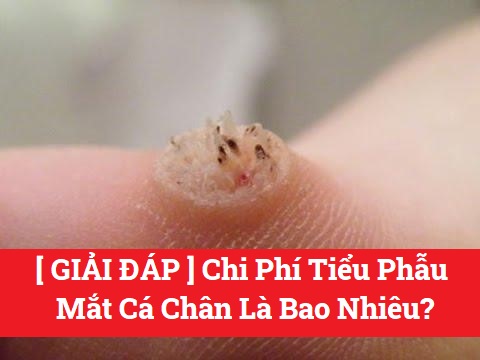 Chi phí tiểu phẫu mắt cá chân